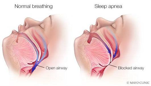 Main Types of Sleep Apnea